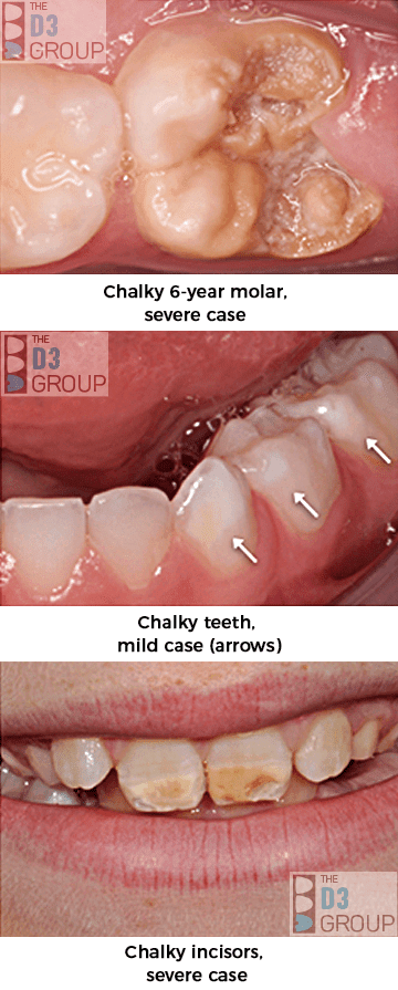 Pic1: 10 yr old front teeth affected by molar hypomin, Pic 2: Extra white spots on molars caused by molar hypomin, Pic 3: 6-year-old crumbly molar caused by molar hypomin