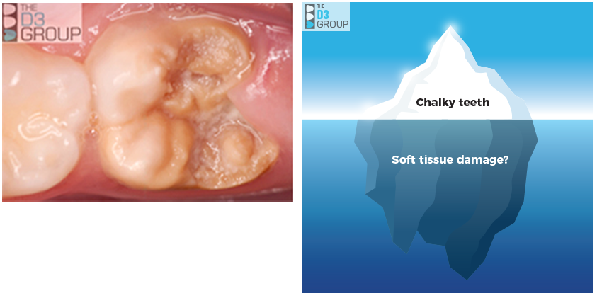 Pic1: Chalky Teeth image showing decay and D3 difference, Pic 2: crumbly chalk pic