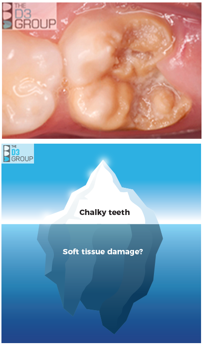 Pic1: Chalky Teeth image showing decay and D3 difference, Pic 2: crumbly chalk pic