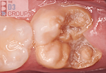 6-year-old crumbly molar caused by molar hypomin