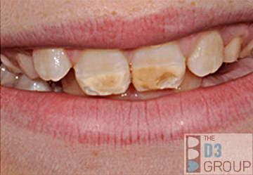 10 yr old front teeth affected by molar hypomin