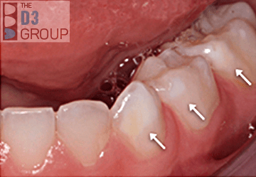 Extra white spots on molars caused by molar hypomin