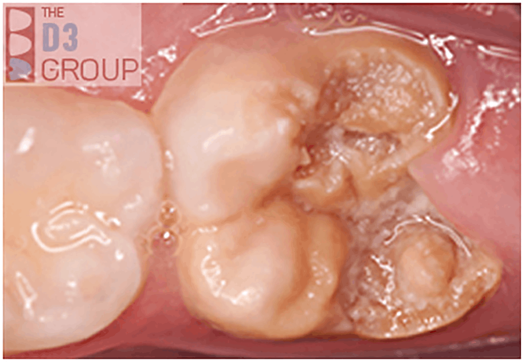 Chalky molar pic